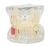 Modelo de enseñanza patológica dental removible, modelo transparente de dientes enfermos para demostrar tratamientos de conducto radicular y