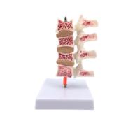 Modelo de esqueleto humano profesional de PVC, modelo de columna lumbar enferma, modelo anatómico de osteoporosis con base for uso educativo.