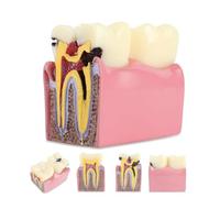 Modelo de estudio comparativo de caries dental (8 x 5 x 9 cm/5 x 6 x 3 pulgadas), modelo de diente con caries, modelo de patología de comparación bilateral de caries,A
