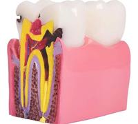 Modelo de estudio comparativo de caries en 6 etapas, modelo de patología dental de comparación bilateral, adecuado para dentistas, pacientes, profesores y estudiantes, investigación y estudio odontoló