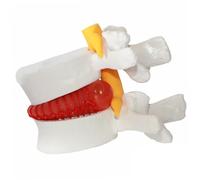 Modelo de hernia de disco lumbar 1.5 veces modelo de columna vertebral de columna vertebral portátil de lente lumbar modelo para presentaciones médicas, de enseñanza, aprendizaje y científica, modelo