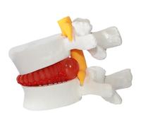Modelo de hernia de disco lumbar anatómico humano, ayudas de enseñanza de alivio del disco herniado, 1.5 veces el modelo de lente lumbar del tamaño de la vida para enseñar, aprender y demostrar