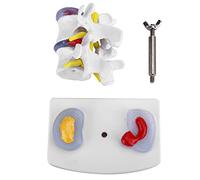 Modelo de hernia de disco lumbar, modelo de demostración de hernia de disco lumbar anatómico Suministros de entrenamiento escolar para la columna vertebral humana