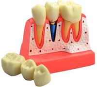 Modelo De Implante Dental: Análisis Removible 4 Veces Demostración De Puente De Modelo De Dientes Análisis De Implante Dental Modelo De Diente para Aprendizaje Y Educación