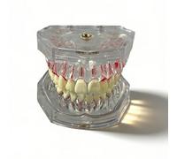 Modelo de implante dental con conducto radicular y cavidad pulpar, modelo anatómico de dientes removibles, modelos didácticos para la educación de pacientes y estudiantes de odontología