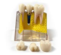 Modelo de implante dental de 4 piezas con puente de corona removible, coronas y raíces dentales removibles para educación, comunicación con pacientes, aprendizaje y laboratorio.
