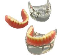 Modelo De Implante Dental - Modelo De 4 Implantes para Sobredentadura - Modelo De Diente De Demostración Transparente para Estudio Modelo De Enseñanza Estándar para Adultos