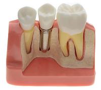Modelo de implante dental para demostración de puente coronario, modelo de dientes extraíbles para enseñanza y comunicación médico-paciente, modelo de dientes demostrativos ampliados