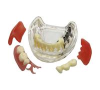 Modelo de implante dental, sobredentadura mandibular extraíble, enseñanza con encías suaves de silicona for fines educativos científicos.(A)