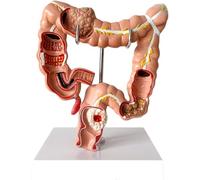 Modelo de intestino grueso humano, modelo de lesión visceral - Modelo de patología del colon, sistema digestivo anatómico, for estudios de educación fisiológica.