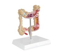 Modelo de lesión colorrectal, serpiente Colon humano, modelo enfermedades patológicas del intestino grueso, organizador médico, anatomía
