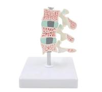 Modelo de lesión ósea por osteoporosis humana de tamaño natural con base de exhibición, muestra de contraste de evolución de 3 vértebras for demostración en el aula