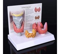 Modelo de nódulo tiroideo, 3:1 que muestra el sistema digestivo patológico de la tiroides Estudio de visualización Modelo anatómico del cuerpo humano Herramienta de enseñanza