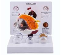 Modelo de ojo con cataratas, modelo de ojo, modelo anatómico del globo ocular con cataratas visibles, for el estudio de la anatomía humana y la enseñanza de ciencias.