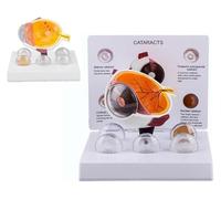 Modelo de ojo de cataratas, herramienta de anatomía del ojo humano para educación, modelo de lesión corneal para investigación oftalmológica, estructura anatómica detallada del ojo