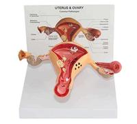 Modelo de Ovario de útero patológico Humano réplica de anatomía del Cuerpo Humano del Sistema reproductivo Femenino para