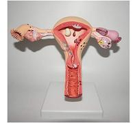 Modelo de Ovario de útero patológico - Modelo de anatomía de órganos Humanos Modelo de Ovario de útero - Modelo reproductivo anatómico médico Modelo de anatomía de Ovario de útero patológic