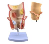 Modelo de patología Rectal Humana, Modelo de acné anorrectal con Base, Herramienta de Entrenamiento médico anatómico, for educación clínica, exhibición de Aprendizaje
