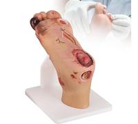 Modelo de Pie Diabético, Escala 1:1 Contraste Patológico Leve y Grave, Anatomía del para Formación Enfermería Podología, Simulación Clasificación Úlceras,Severe