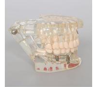 Modelo de restauración dental para cirugía oral y exhibición de accesorios de implantes, modelo dental patológico educativo para la interacción del paciente y el médico