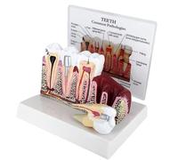 Modelo de sección transversal de dientes para educación y comunicación con el paciente, ayuda a la enseñanza de la enfermedad de la caries con pantalla de dientes desmontable