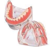 Modelo de sobredentadura Dental, modelo de dientes de enfermedad de implante, demostración de 2 implantes, para enseñar, estudiar, mostrar, comunicación con el paciente