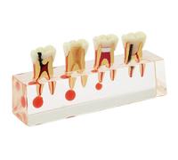 Modelo de tratamiento endodóntico 4 etapas. Herramienta demostración ortodoncia for el del conducto radicular y la educación paciente