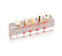 Modelo de tratamiento endodóntico de 4 etapas para el estudio de dientes de enseñanza Modelo de comunicación médico-paciente