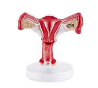 Modelo de útero patológico a tamaño real con ovario desmontable, representación anatómica del sistema reproductor femenino