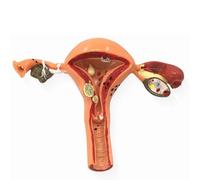 Modelo de útero patológico Modelo anatómico del Sistema Reproductor Femenino Modelo de anatomía uterina y ovárica for la educación en anatomía y fisiología Humana Modelo de órganos