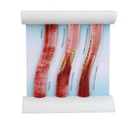 Modelo de Vaso Sanguíneo de Lipoproteínas LDL, Herramienta Anatómica de Enseñanza de Lipoproteínas de Baja Densidad, Exhibición en 3 Etapas de la Progresión de la Enfermedad Arteri