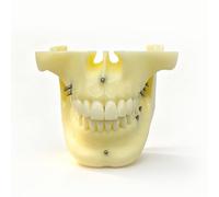 Modelo dental básico de implantes dentales para la enseñanza de estudios odontológicos e investigación médica.