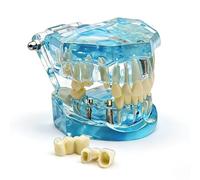 Modelo dental de reparación neural, tipodonto educativo fantoma dientes extraíbles anatómicos para la escuela de odontología, modelos transparentes para enseñar patología, material didáctico(blue)