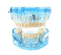 Modelo dental, modelo de dientes de demostración, modelo de dientes de implante de 9 x 7 x 6 cm con dientes extraíbles, modelo de dientes para enseñanza, modelo de dientes enfermos para enseñanza