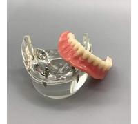 Modelo Dental - Modelo de Dientes de Implantes Dentales- Sobredentadura Dental Mandibular Inferior 2 Implantes Demo para Enseñar y Estudiar
