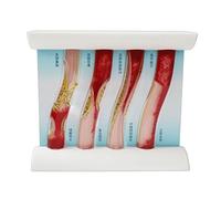 Modelo dinámico de vasos sanguíneos de simulación para enseñanza médica con efecto realista de flujos sanguíneos y comparación patológica, modelo vascular de enseñanza clínica