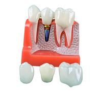 Modelo educativo de implante dental, tamaño 4X, corona de demostración y exhibición de puente con base