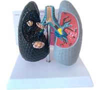 Modelo Escritorio Para Comparar Pulmones Sanos Y Afectados Por El Tabaquismo, Modelo Broncopulmonar Humano, Con Tarjeta Explicativa En Inglés, Modelo Anatomía Pulmonar Con Características Patológicas