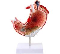 Modelo Gástrico Patológico Humano, Demostración De Enfermedades Gástricas Comunes, Herramienta De Ayuda Visual Para Lesiones Estomacales, Con Soporte De Exhibición, Para Investigación De Patología