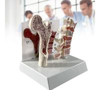 Modelo Osteoporosis Óseo con Corte Fémur y Columna Lumbar Degenerativa, Modelo Anatómico Educativo para Escuela Médica Clínica