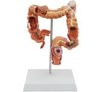 Modelo patológico de Colon Modelo de intestino Grueso Enseñanza de anatomía médica en el Departamento de Gastroenterología Departamento de Anorrectal Herramienta didáctica Material didáctico