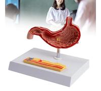 Modelo Patológico de Estómago Humano - Simulador del Sistema Digestivo con Gastritis, Úlceras y Cáncer Gástrico - Material Educativo Médico para Gastroenterología y Pacientes