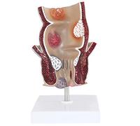 Modelo Patológico Rectal Modelo De Hemorroides Enfermedad Anorrectal Es Adecuado Para La Demostración De Enseñanza Médica