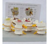 Modelo Profesional De VéRtebras Lumbares Humanas De 4 Etapas, Modelo De Columna Vertebral Humana, DegeneracióN óSea Y Osteoporosis Avanzada, Para Aprendizaje Y EducacióN