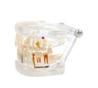 Modelo transparente de dientes de implante con extraíble para estudio, dentista, oficina, conferencias médicas, modelos de uso para estudiantes, modelo de resina para educación del paciente