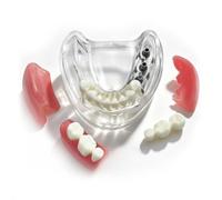 Modelo transparente de implante tipodonto dental con 3 dientes superiores para demostración. Modelo desmontable con visión transparente. Modelo de enseñanza dental adecuado