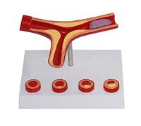 Modelos anatómicos, Modelo anatómico de vaso sanguíneo. trombo for material didáctico médico