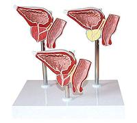 Modelos anatómicos, Modelo anatómico del sistema urinario humano. de enfermedad la glándula fisura anterior (tres partes). Herramienta presentación escolar