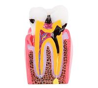 Modelos de estudio de comparación de caries, modelo de dientes de educación de anatomía dental de dentista