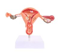 Modelos de lesiones patológicas del ovario y útero humanos for la enseñanza médica (Anatomía)